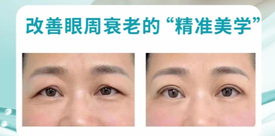 成都李波提眉手术2025年12月价格:真实测评来了,1.5万左右,术后成效分享 成都李波提眉手术后多久能变好?这些注意事项要记牢www.236z.com