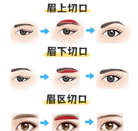 成都李波提眉手术2025年12月价格:真实测评来了,1.5万左右,术后成效分享 成都李波提眉手术12月价格表大公开!1.5万起,这些项目收费明细我帮你拆透了