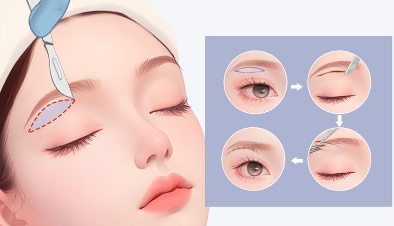 成都李波提眉手术2025年12月价格:真实测评来了,1.5万左右,术后成效分享 之后说几句:成都提眉价格透明,这些细节要注意