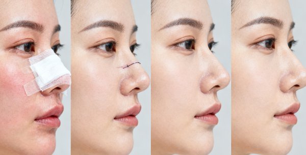 李战强和梁晓健谁做鼻子做得好?李战强精于高难鼻修复,梁晓健擅打自然动态鼻,风格不同都高端! 二、李战强做鼻子:高难鼻修复大拿,复杂失败实例都能“救”